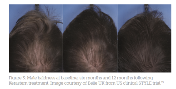 Using Stem Cells For Hair Restoration Aesthetics