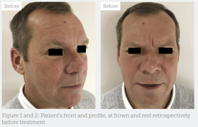 Male-specific Approach to Toxin Treatment - Aesthetics