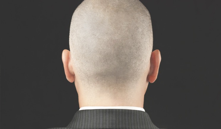 The Role Of Scalp Micro Pigmentation Treatment In Follicular Unit
