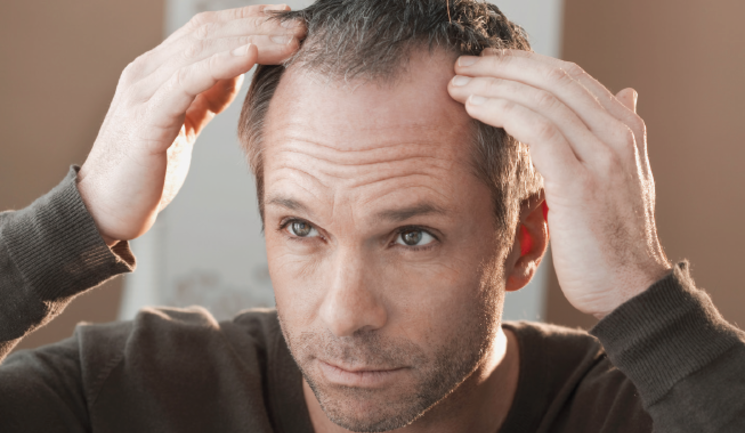 Hair Loss Treatments - Aesthetics