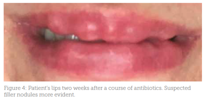 Case Study Lip Filler Infection And Nodules Aesthetics Manbetx 