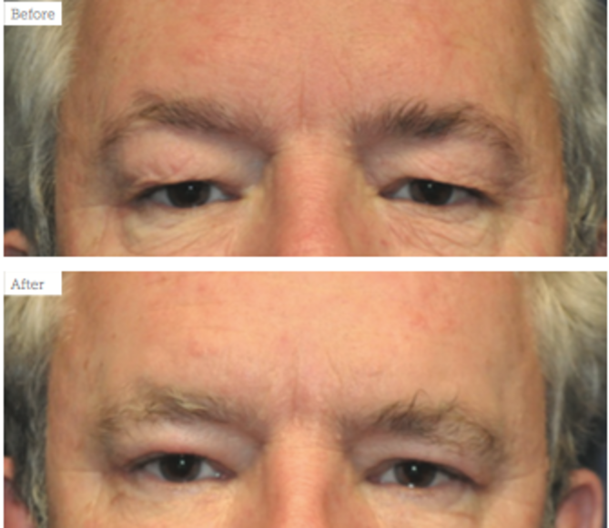 how to avoid brow ptosis with botox