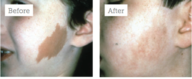 revlite laser treatment near me