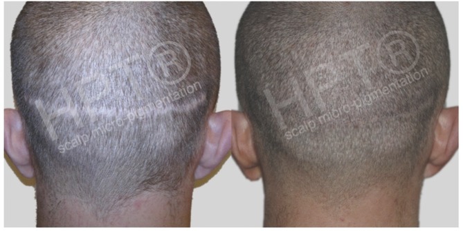 The Role Of Scalp Micro Pigmentation Treatment In Follicular Unit