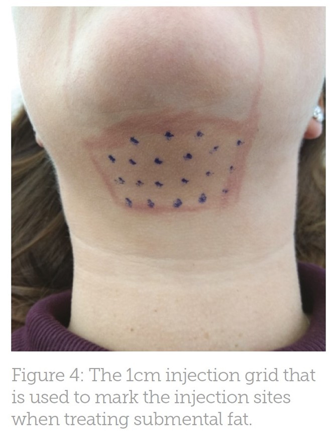 fat injections dissolving results conclusion