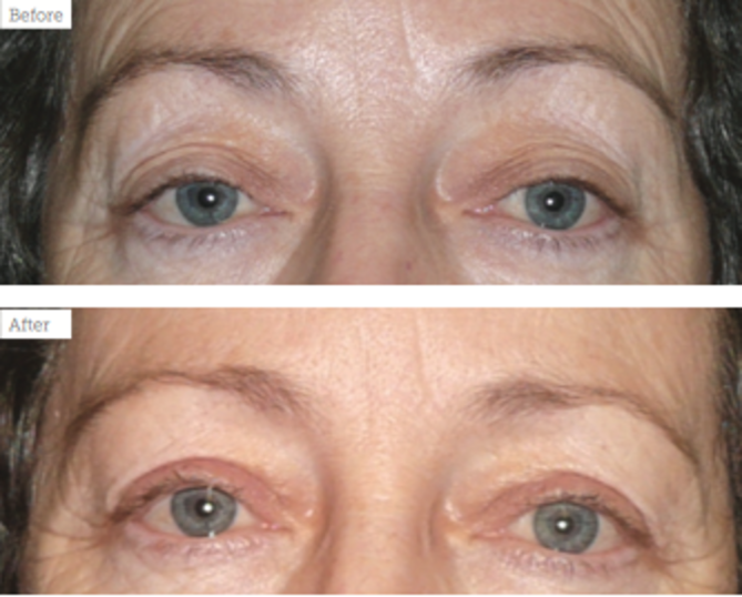 can ptosis be corrected