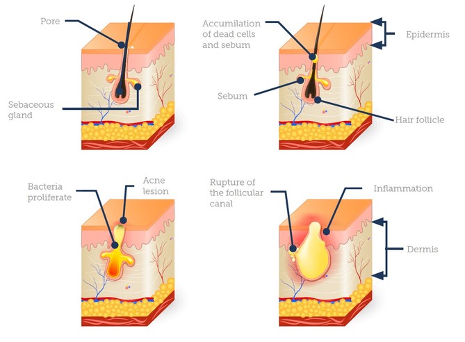 Treating Acne and Scarring - Aesthetics