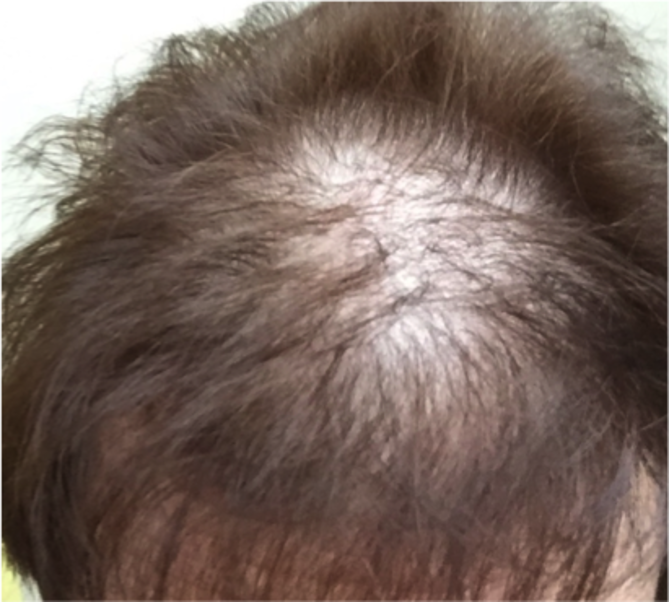 Dr Cole Discusses Female Pattern Hair Loss  Cole Hair