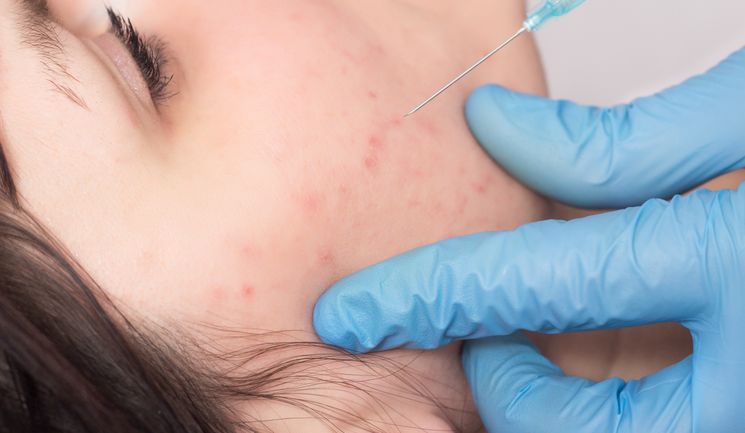 Treating Acne Using Botulinum Toxin - Aesthetics