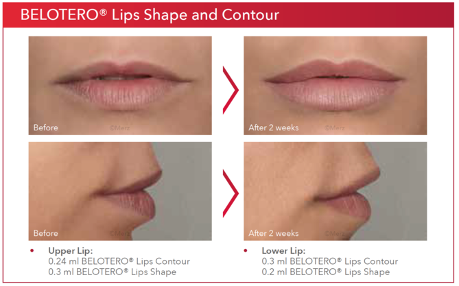 Belotero Lips Contour 0.6 мл. Белотеро Липс 0.6мл Шейп 0.6. Белотеро Интенс 0.6 мл в губы. Белотеро филлер 0.6 мл.
