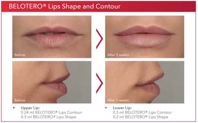 Контур отзывы. Belotero Lips Contour 0.6 мл. Белотеро Липс 0.6мл Шейп 0.6. Белотеро Липс контур. Белотеро Шейп и контур.