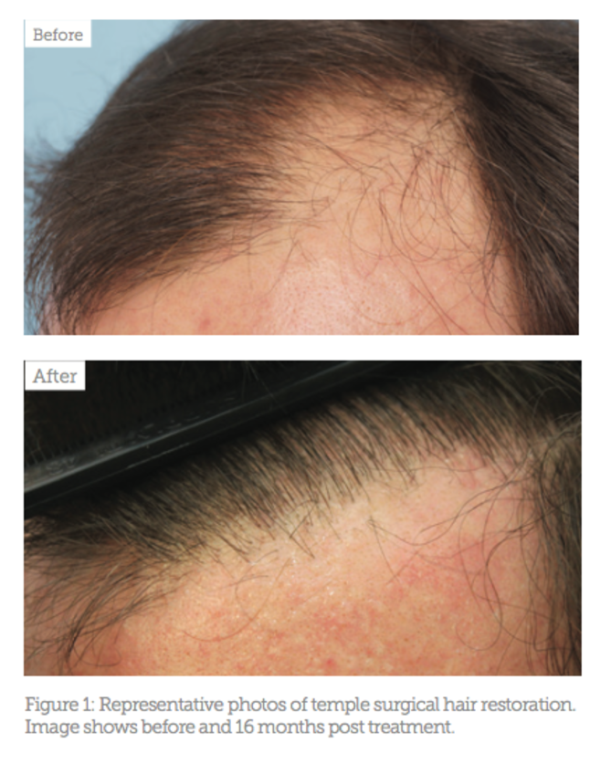 Treating Receding Hairlines in Men Under 30 - Aesthetics