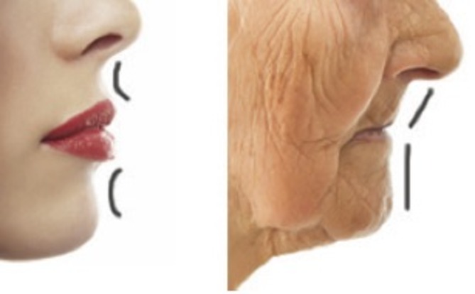 perioral-ageing-aesthetics