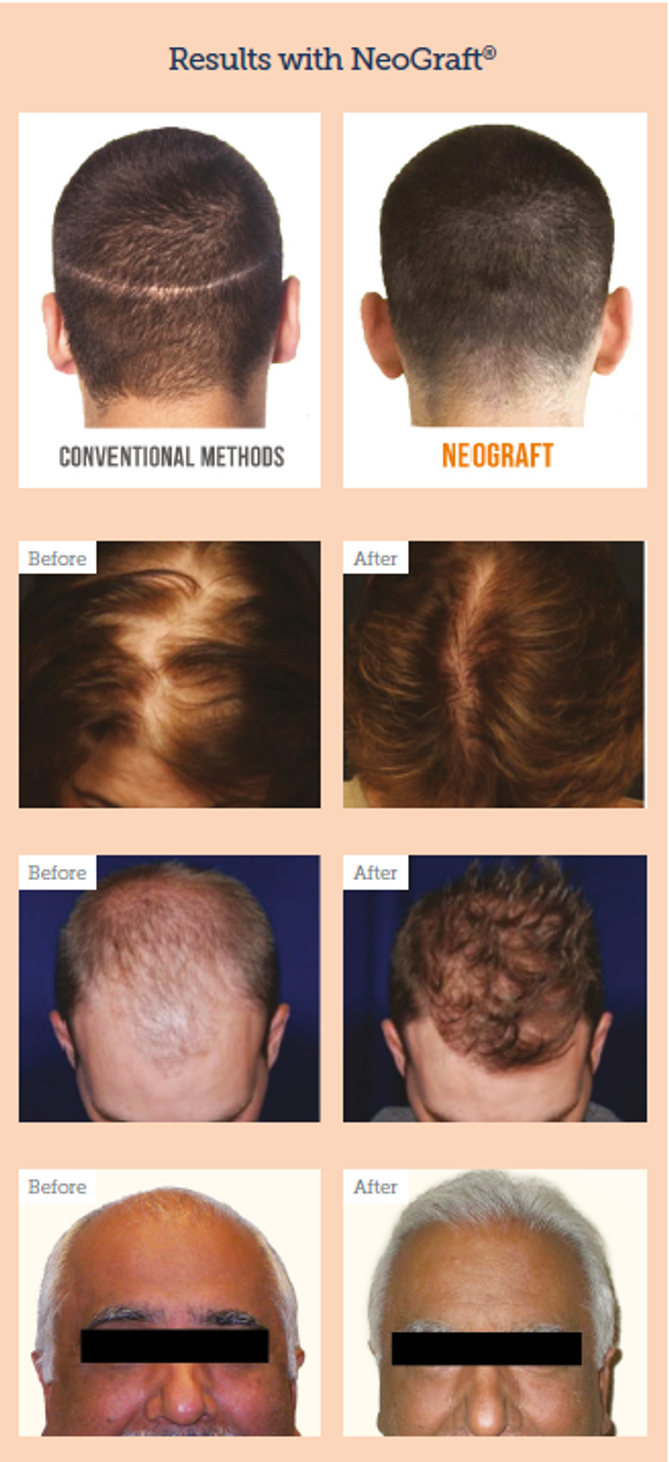 Advertorial: Hair transplants, the new growth industry - Aesthetics