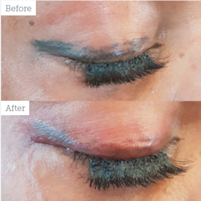 lower eyelid tattoo removal