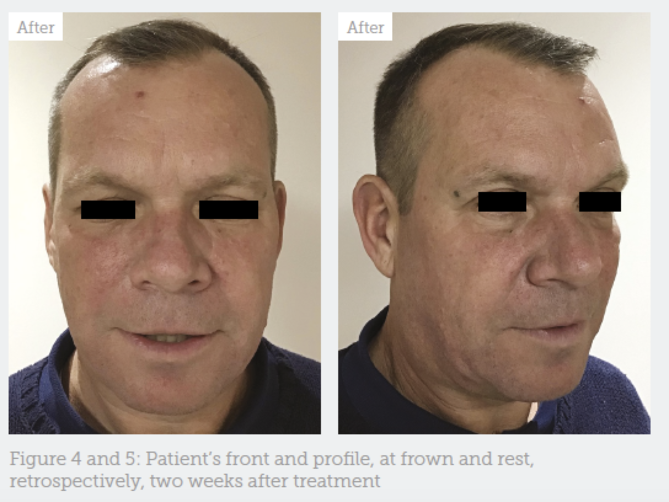 Male-specific Approach to Toxin Treatment - Aesthetics