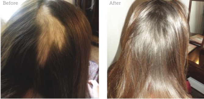 Special Feature: Managing Hair Loss - Aesthetics
