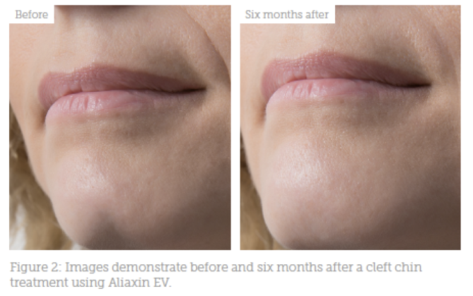 HOW TO GET RID OF DIMPLE LINES Programsrun