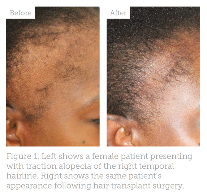 Female Hair Transplant  PA  The Griffin Hair Restoration Center