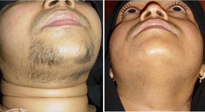 hirsutism chin