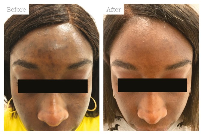 Case Study: Treating Acne and Hyperpigmentation - Aesthetics