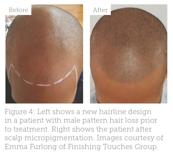 Treating Hair Loss In Afro Textured Hair Aesthetics