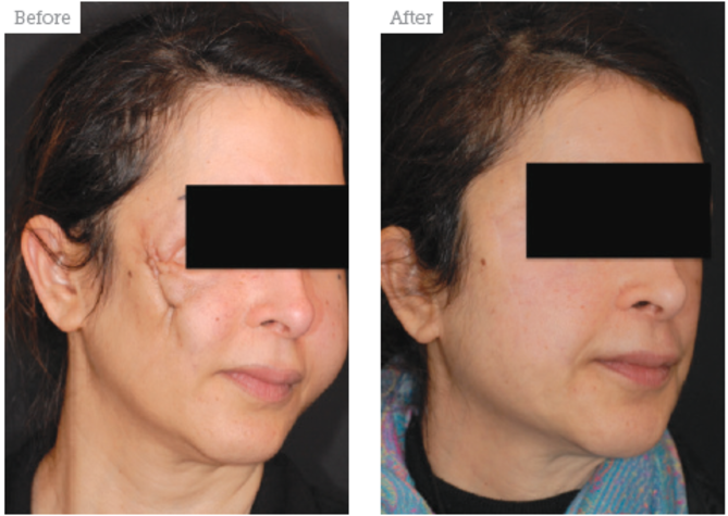 Permanent Dermal Filler Complications 