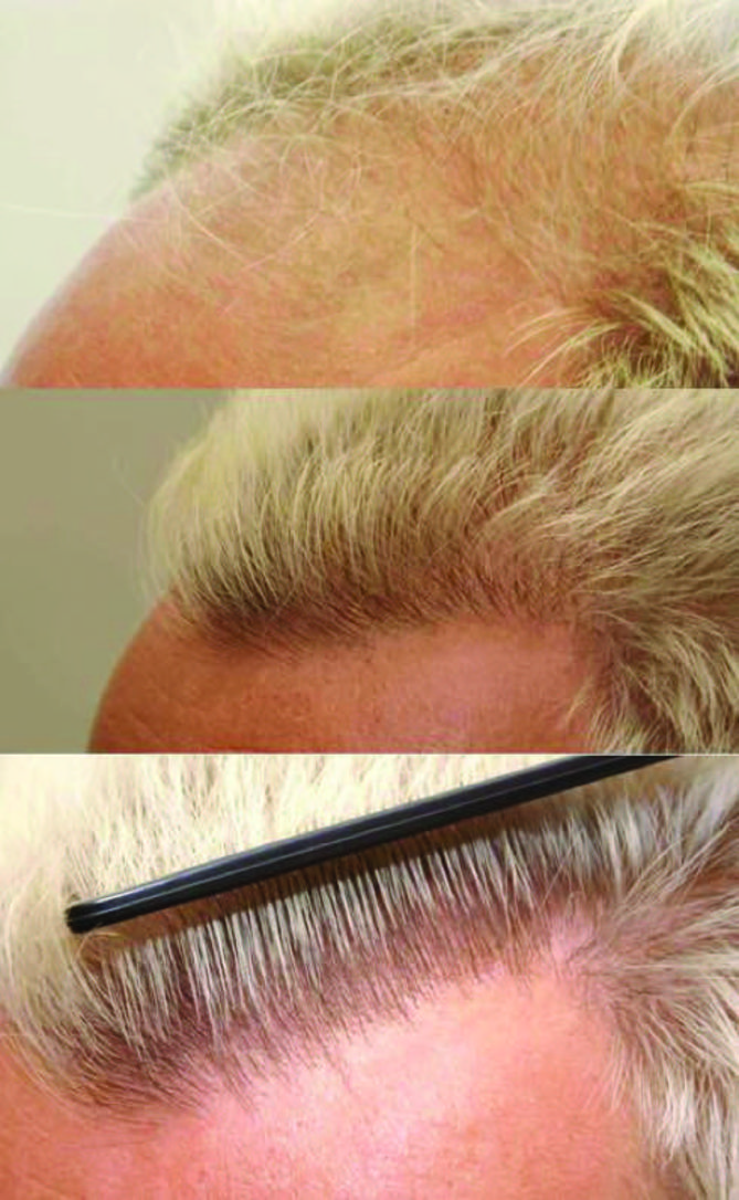 hair transplant techniques