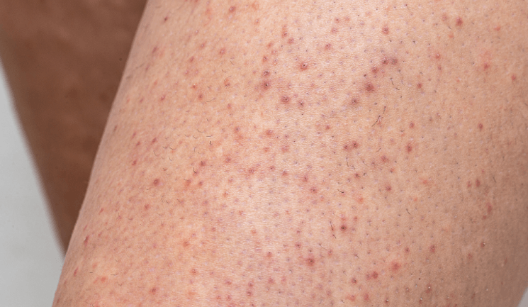 Keratosis Pilaris Atrophicans Faciei