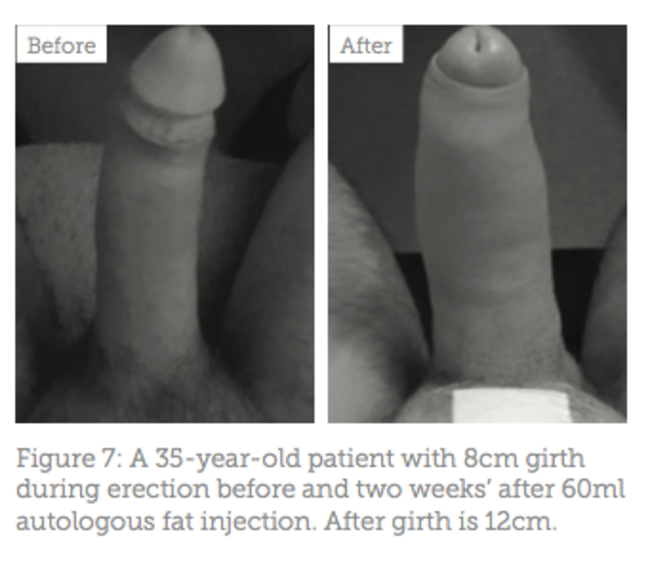 Penis girth augmentation.