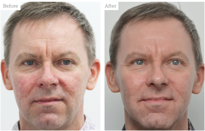 Case Study: Rejuvenating Male Skin - Aesthetics