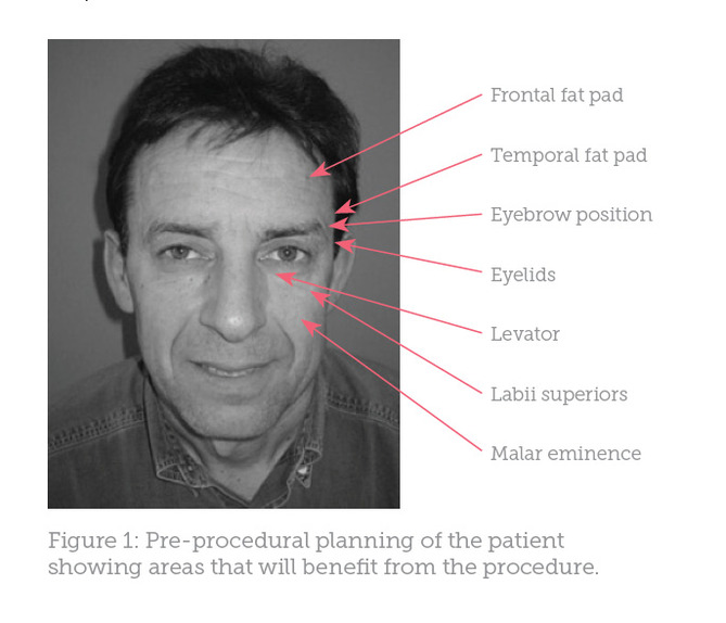 Case Study Male Facial Rejuvenation Aesthetics